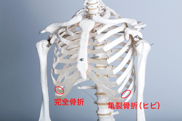肋骨骨折のリアル：症状や治療方法、完治までの生活をまとめ ...